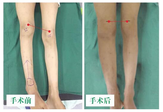 女孩墜梯右腿縮短5cm，幸得醫(yī)生及時(shí)診治恢復(fù)正常腿型