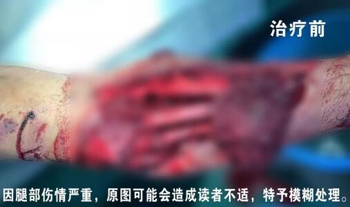 感謝安利醫(yī)院挽救了我的腿，沒(méi)有讓我落下殘疾……”