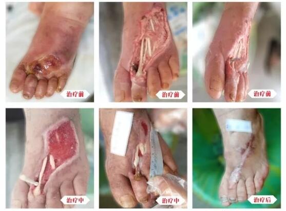 糖尿病并發(fā)癥有多可怕，及時(shí)治療糖尿病足避免截肢！