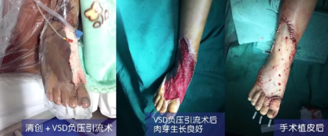 車禍猛如虎，救治如“華佗” ，手術(shù)＋康復(fù)，8歲小女孩車禍后日漸康復(fù)行走
