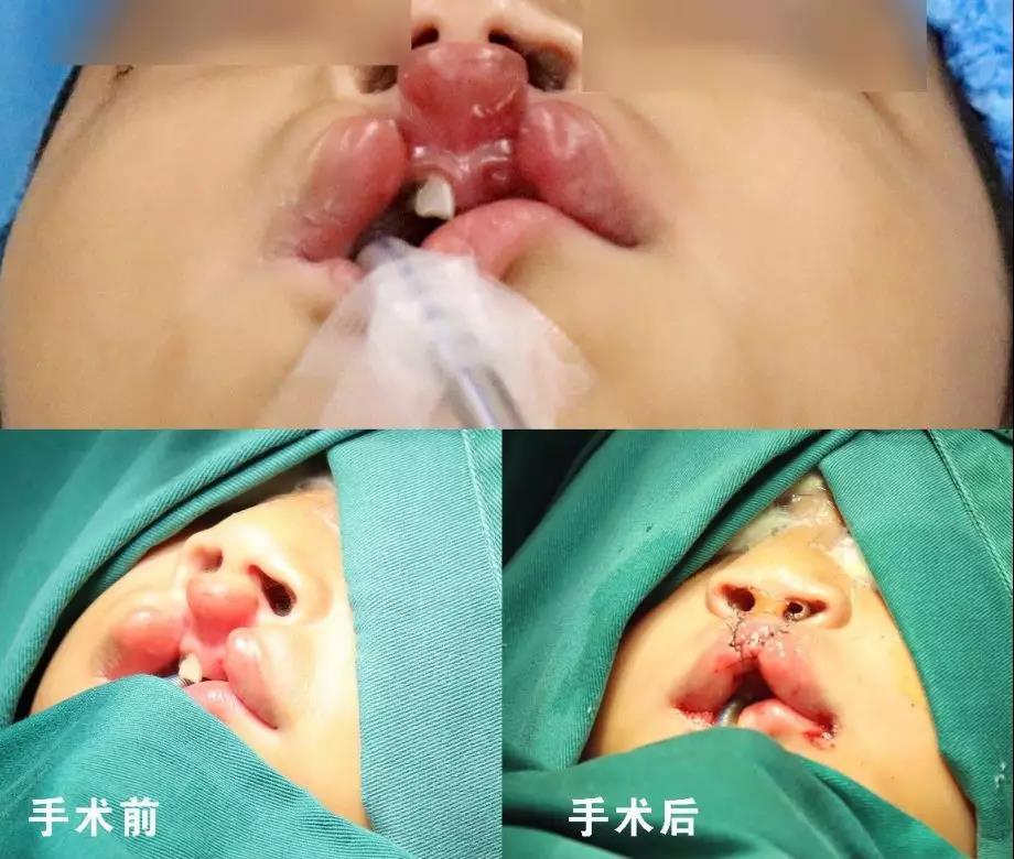 唇腭裂盡早治療消除孩子自卑心理，快樂成長！