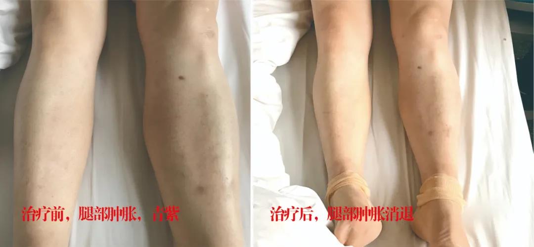 下肢靜脈血栓多年頑疾反復(fù)腫痛——疾病不容等待，早治療，早健康！