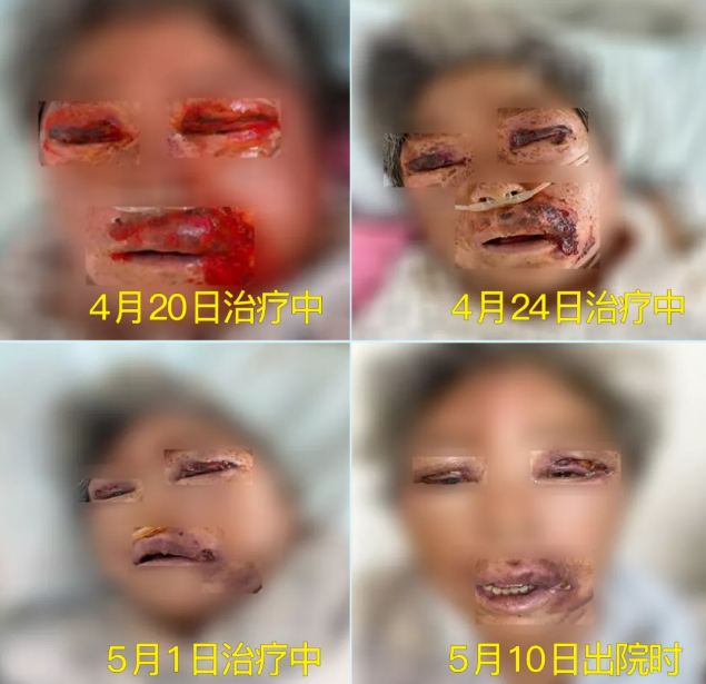 膿毒血癥（急性頜面部蜂窩組織炎）多學(xué)科聯(lián)合會診，幫助患者成功治愈！