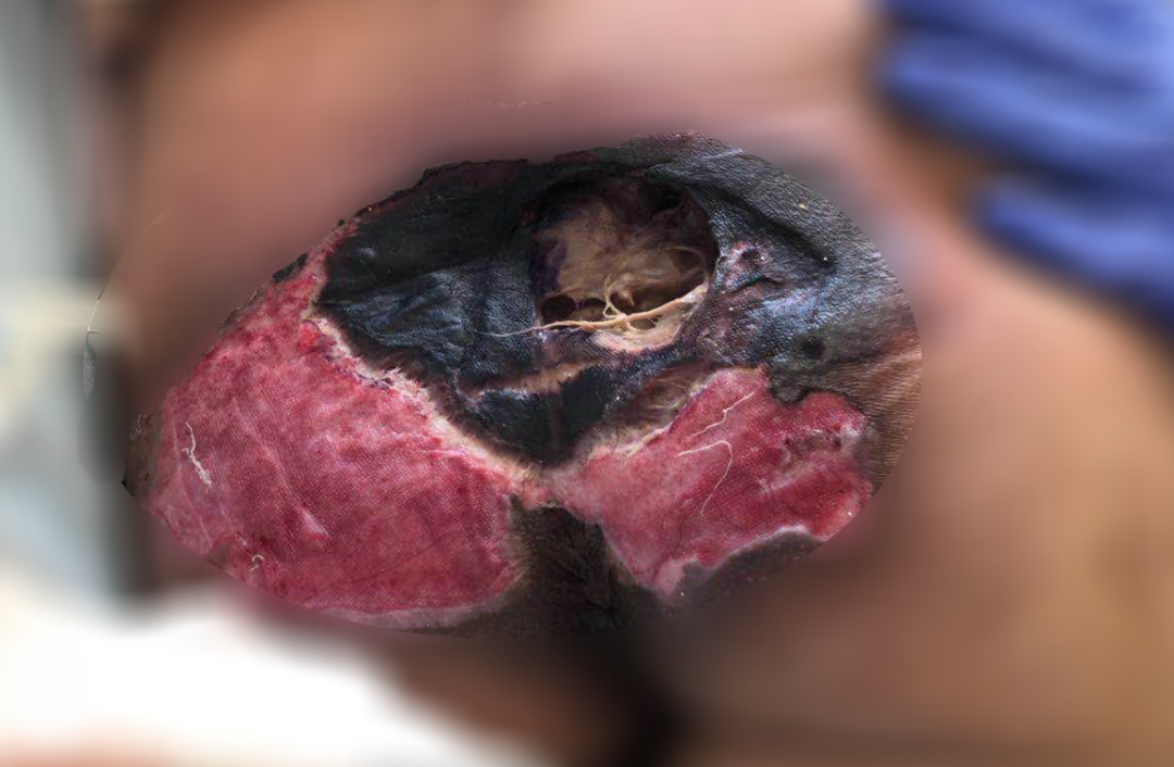 癱瘓3年的女患者臀部居然變成這樣?！