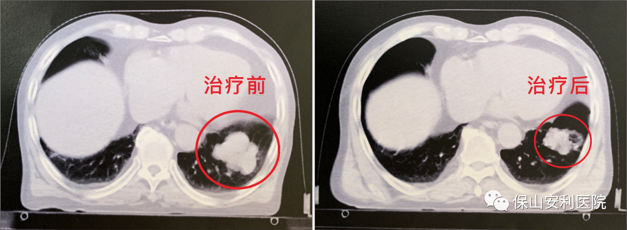 不做手術(shù)，早期肺癌也能根治！