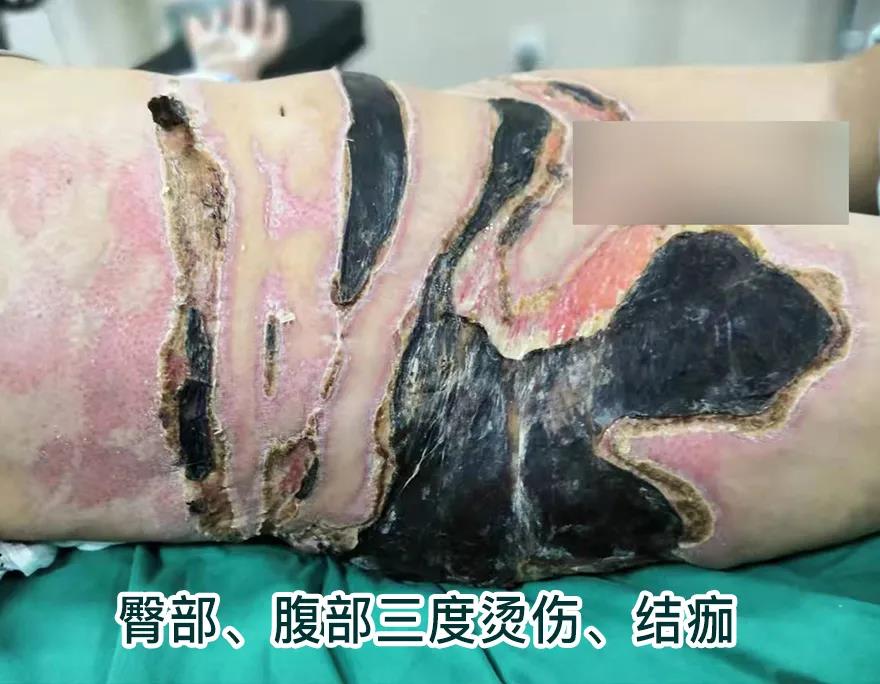 【保山安利醫(yī)院】80歲老人不慎燒傷，導(dǎo)致腹部、右側(cè)臀部大面積創(chuàng)傷，經(jīng)植皮治療創(chuàng)面逐漸愈合