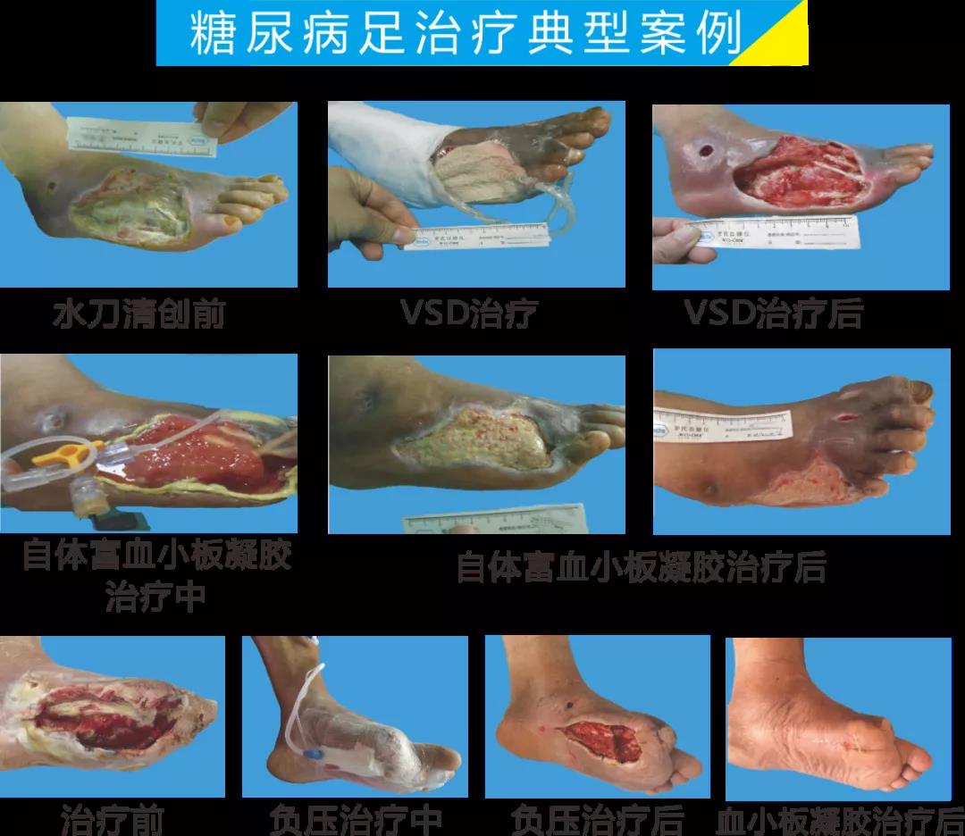 截肢、失明，甚至……，我們要做的是將糖尿病并發(fā)癥遏制在搖籃里！