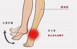 【保山安利醫(yī)院—健康科普】什么是足下垂！你了解嗎？
