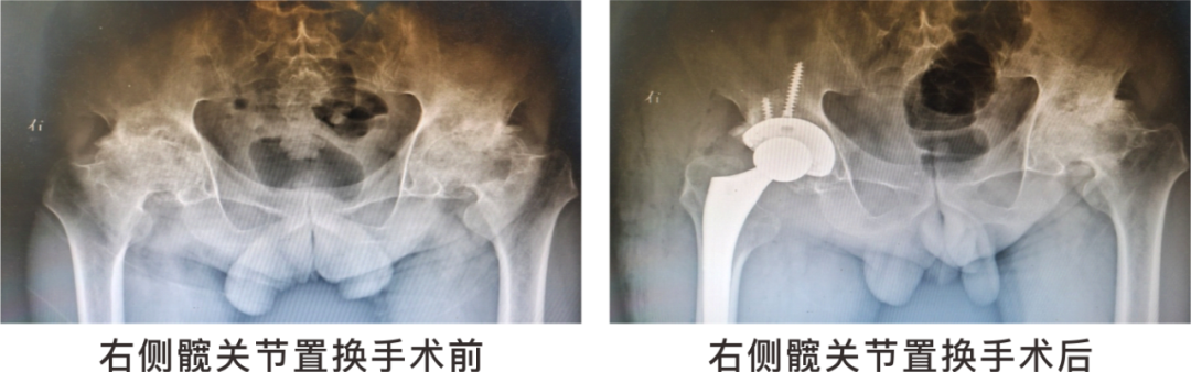 【保山安利醫(yī)院】長(zhǎng)期飲酒導(dǎo)致雙側(cè)股骨頭壞死，髖關(guān)節(jié)置換后重獲運(yùn)動(dòng)功能！