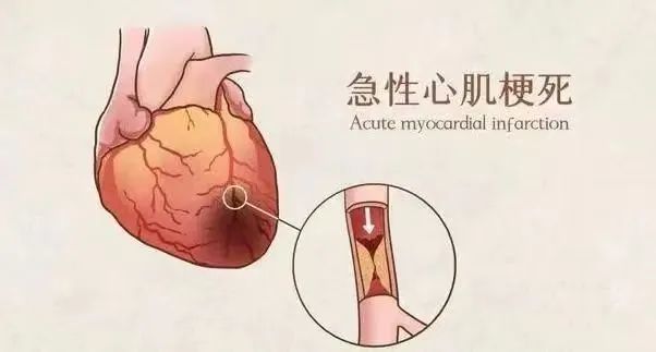 【保山安利醫(yī)院】11月20日“心梗救治日” 時間就是心肌，時間就是生命！